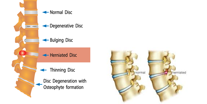 Are You At Risk Of Herniated/Slipped/Ruptured Disc?