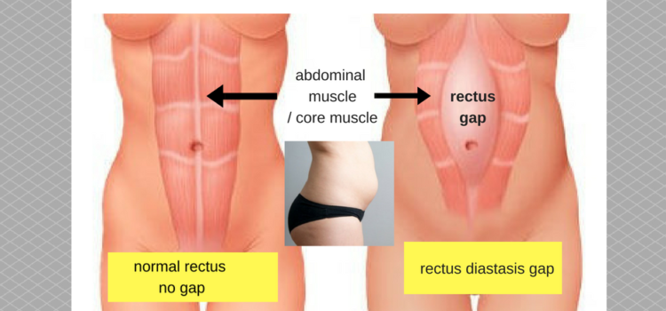 What is a Tummy Gap?