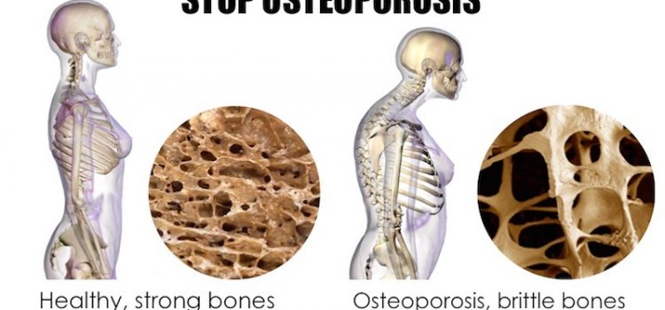 World Osteoporosis Day- ‘Love Your Bones’