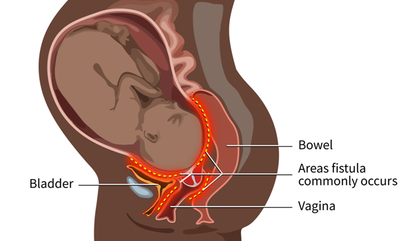 Have You Heard About Fistula?