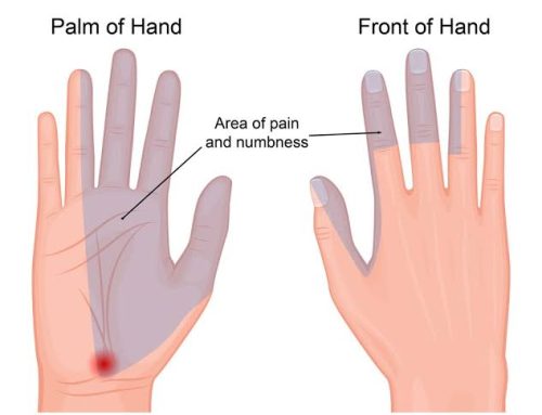 carpal tunnel syndrome