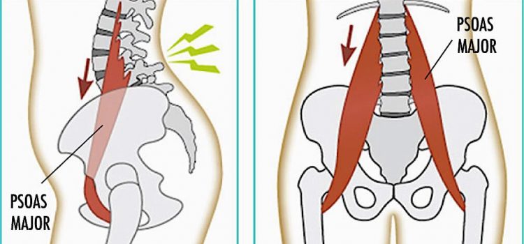 The ‘Psoas Syndrome’