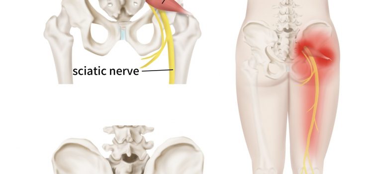 Could You Be Suffering From Piriformis Syndrome and Not Sciatica?