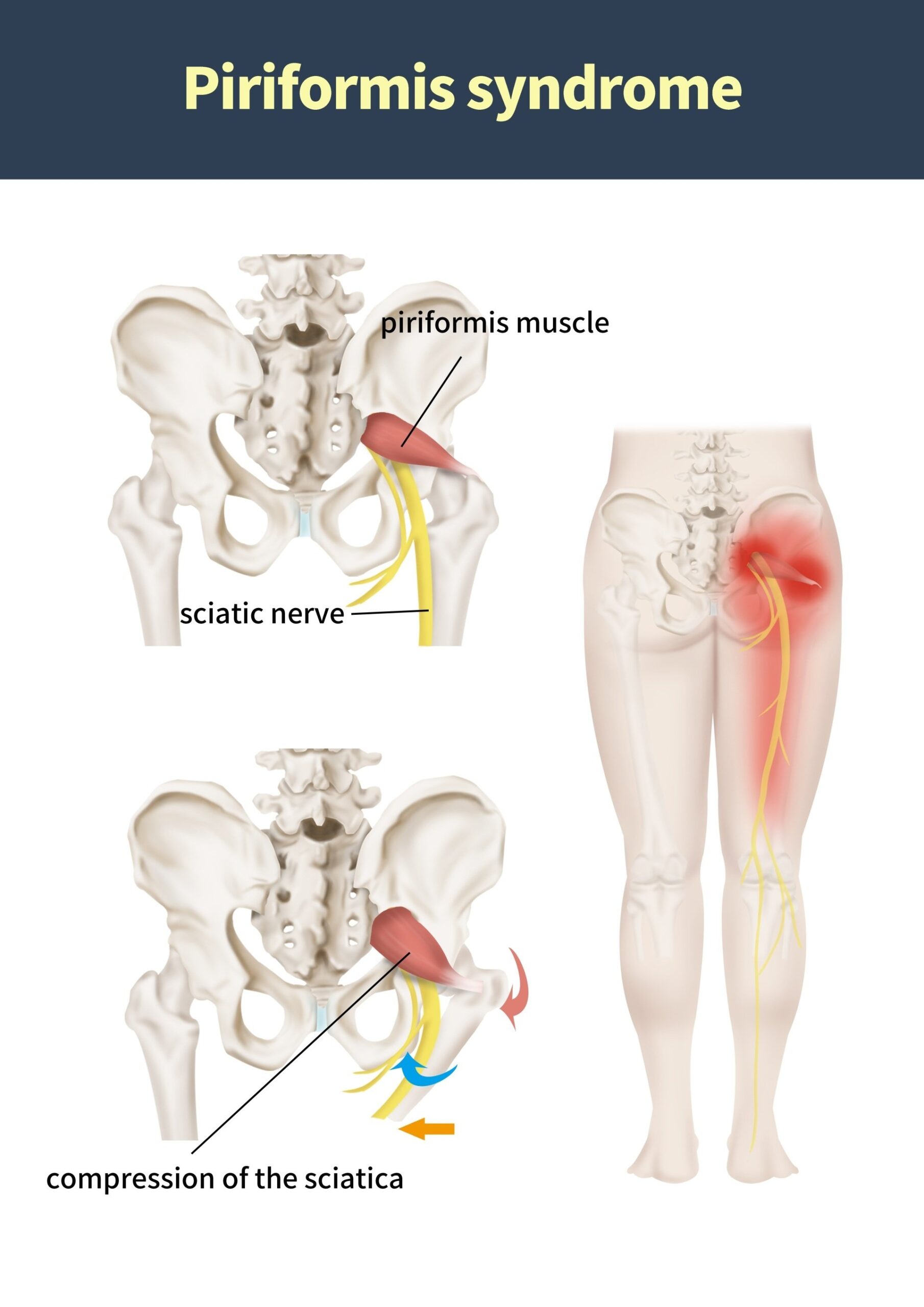 Could You Be Suffering From Piriformis Syndrome and Not Sciatica?