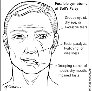 Have You Ever Heard About Bell’s Palsy?