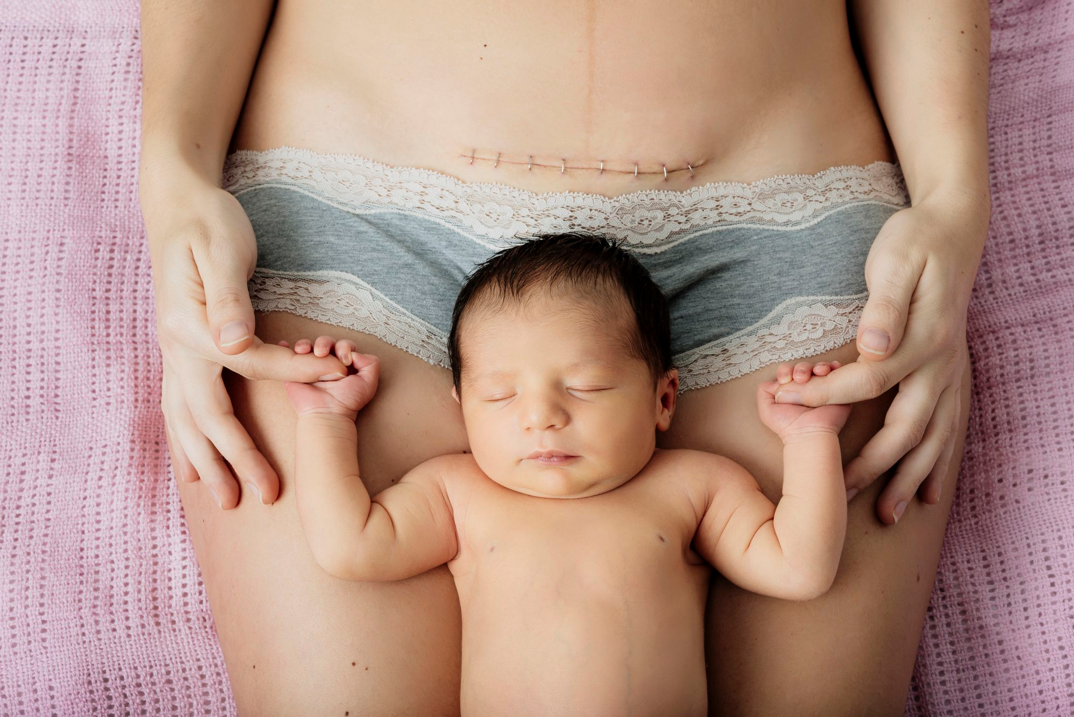 Why You Need To Mobilize Your Cesarean Scar.
