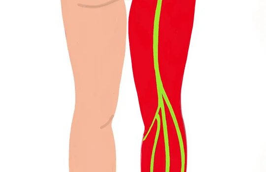 Debunking Sciatica Myths: Understanding Causes, Symptoms, and Prevention