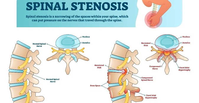 Lumbar Stenosis Pain and Exercises to Help