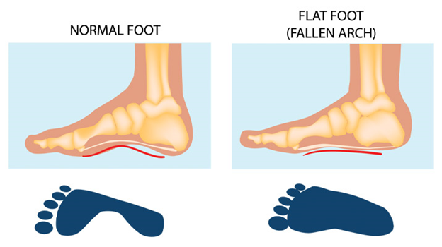 Flat Feet And Back Pain: Understanding The Connection And Finding Relief