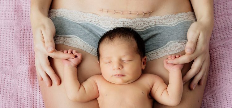 Why You Need To Mobilize Your Caesarian Scar