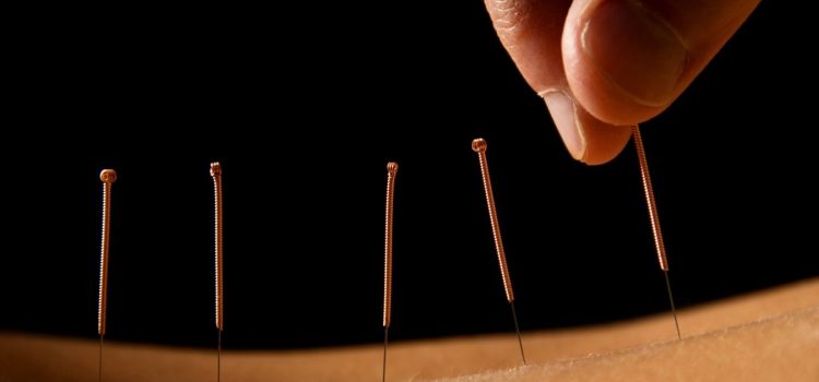 What Is Dry Needling/Ims And Is It Right For Me.