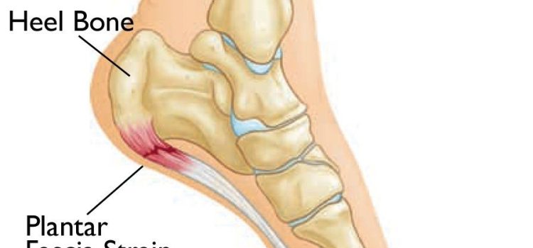 How Plantar Fasciitis Affects Movement And Function.