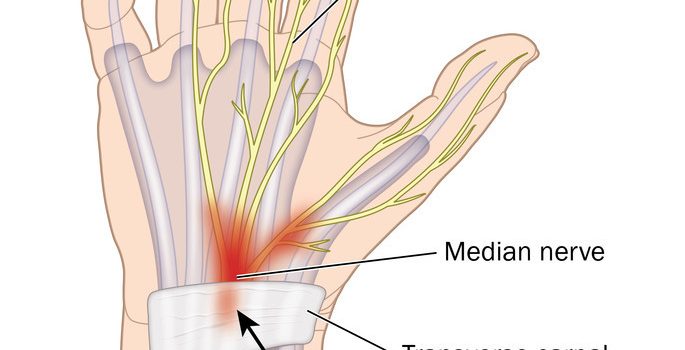 More Than A Wrist Problem.