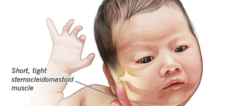 Understanding Torticollis: Causes, Symptoms, and Effective Treatment Options.