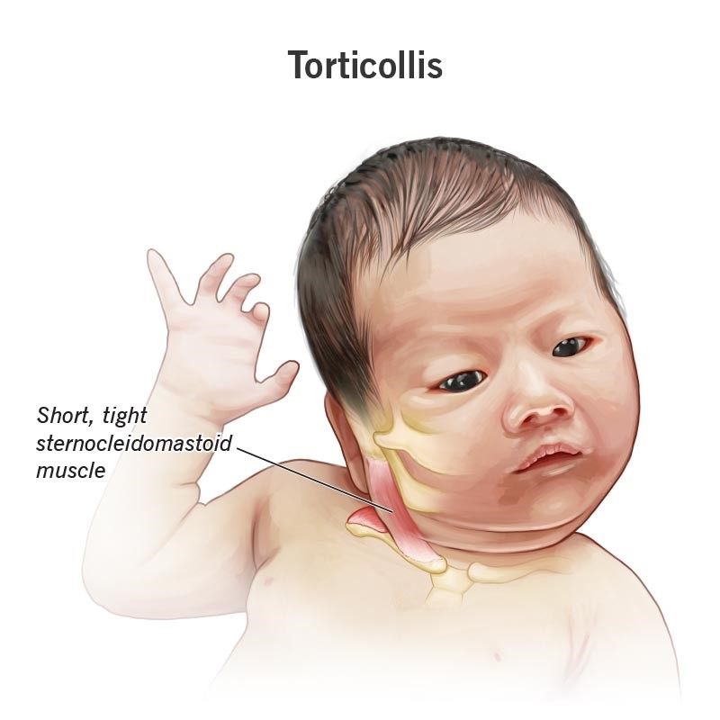 Understanding Torticollis: Causes, Symptoms, and Effective Treatment Options.