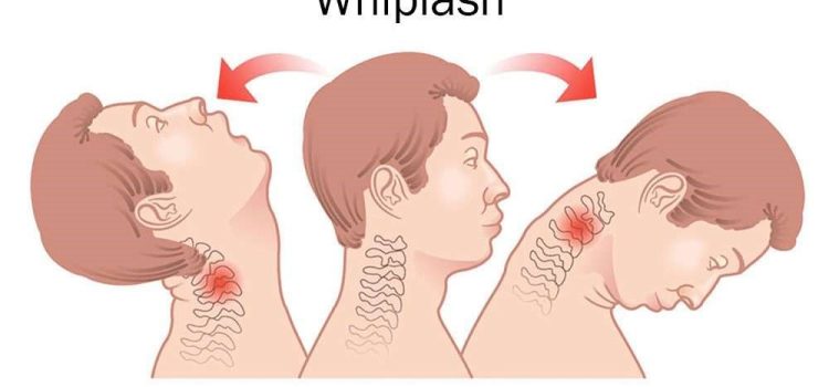 Understanding Whiplash: Causes, Symptoms, and Treatment Options