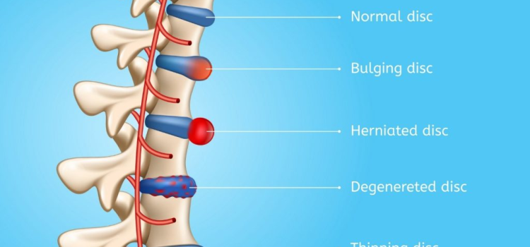 Managing Degenerative Disc Disease: What to Avoid and How to Slow Its Progression