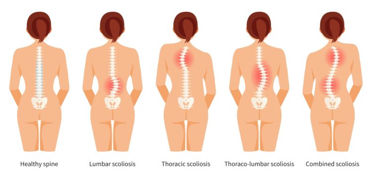 Understanding Scoliosis: Types, Treatments, and When to Seek Help