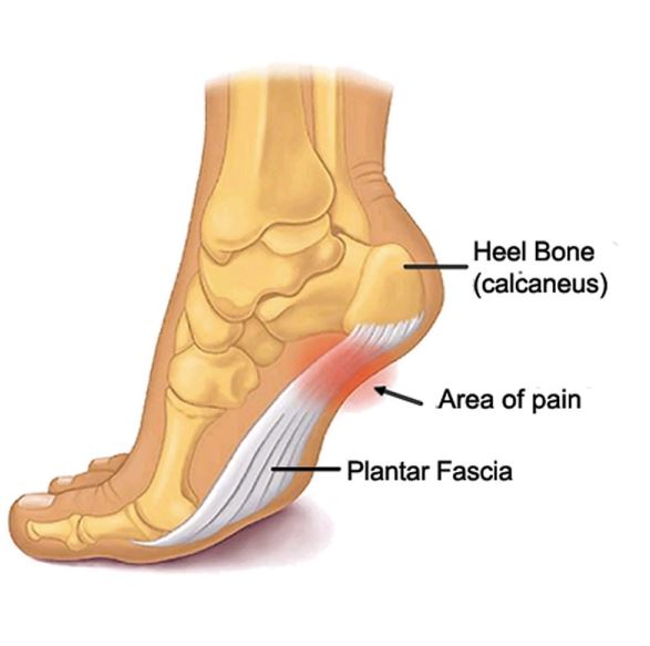 Planter-Fasciitis